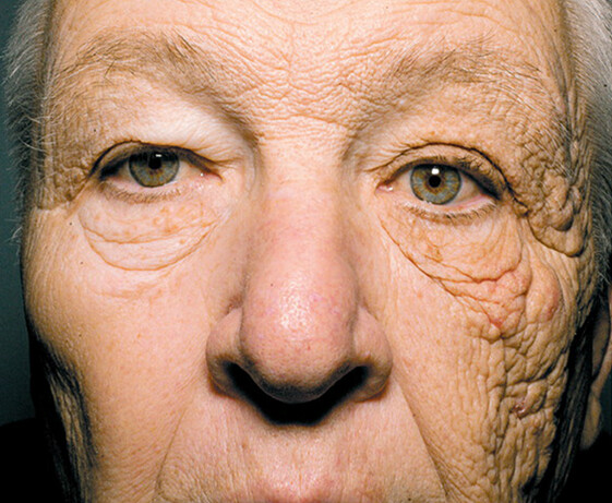 This is what 28 years of driving in the sun can do to half your face.
