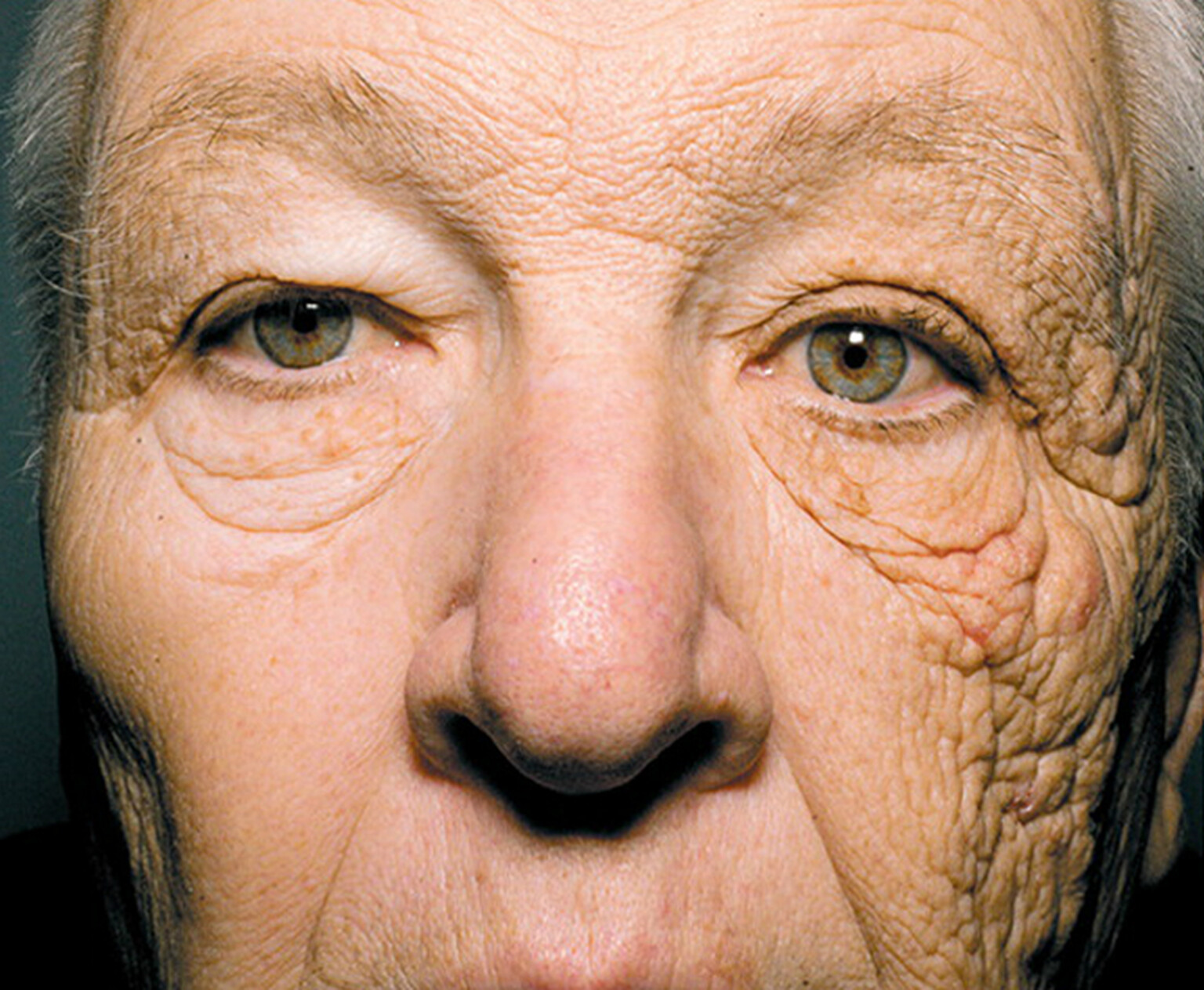 Years of driving in the sun causes man's face to wrinkle like a prune